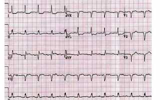 Топическая диагностика инфаркта миокарда экг