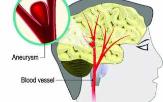 Врожденная аневризма сосудов головного мозга