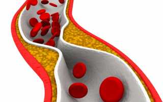 Сужение правой позвоночной артерии симптомы
